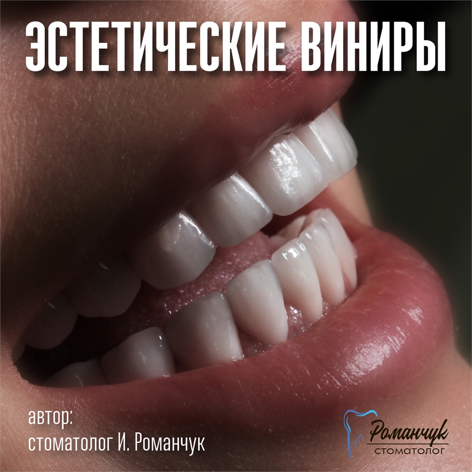 dental-veneers-3