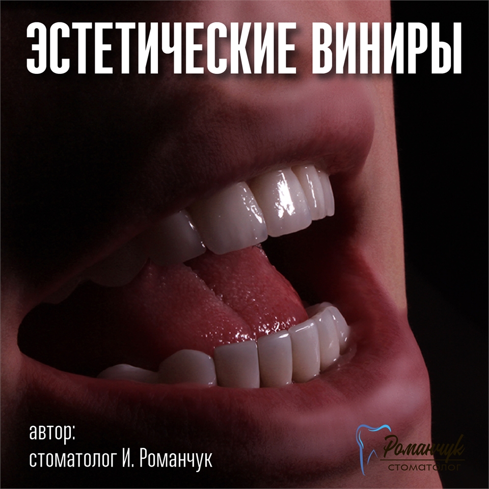 dental-veneers-5