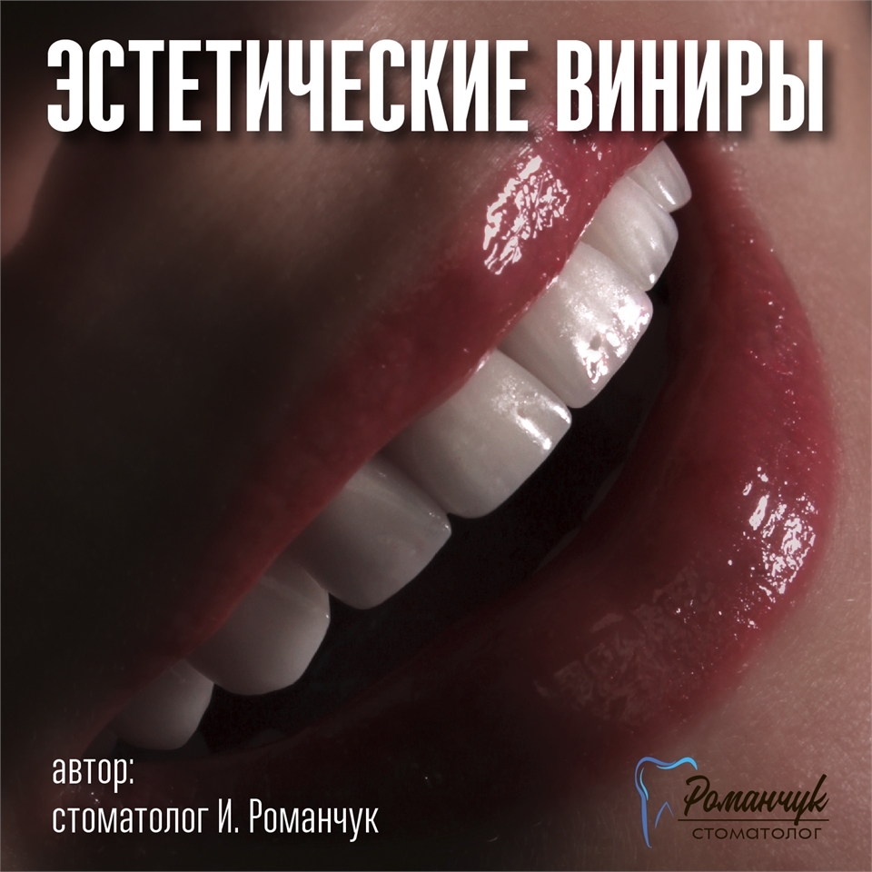 dental-veneers-1