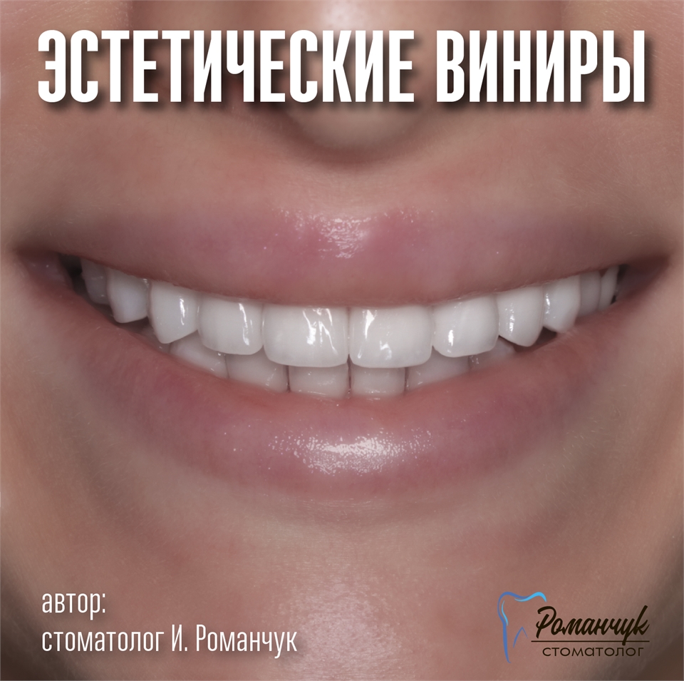 dental-veneers-11