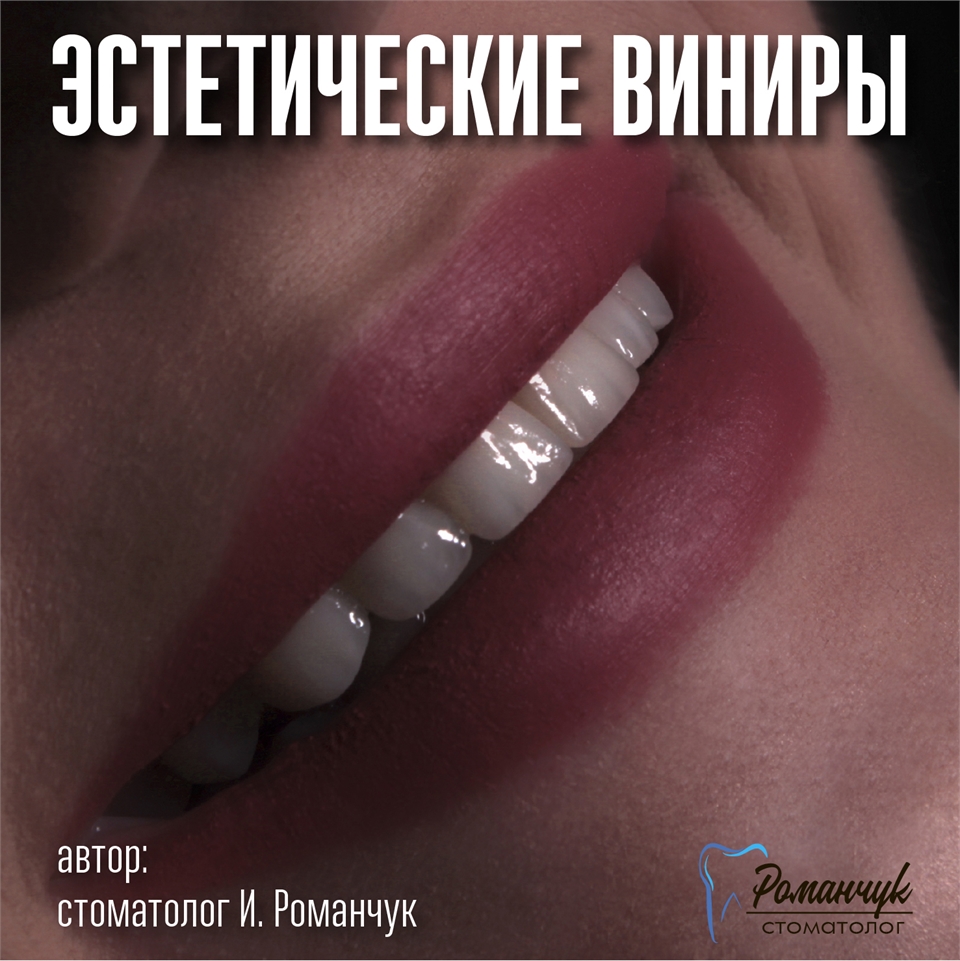 dental-veneers-7