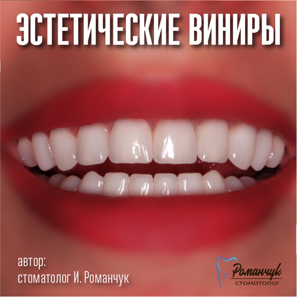 dental-veneers-9