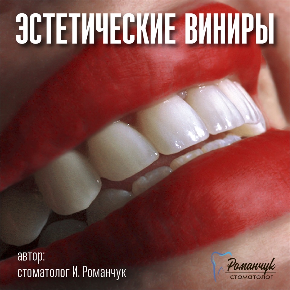 dental-veneers-4