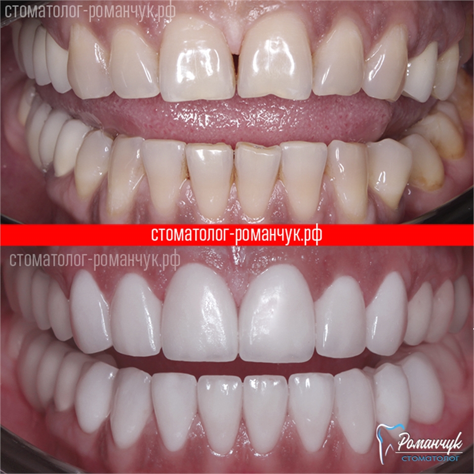 dental-veneers-case-2