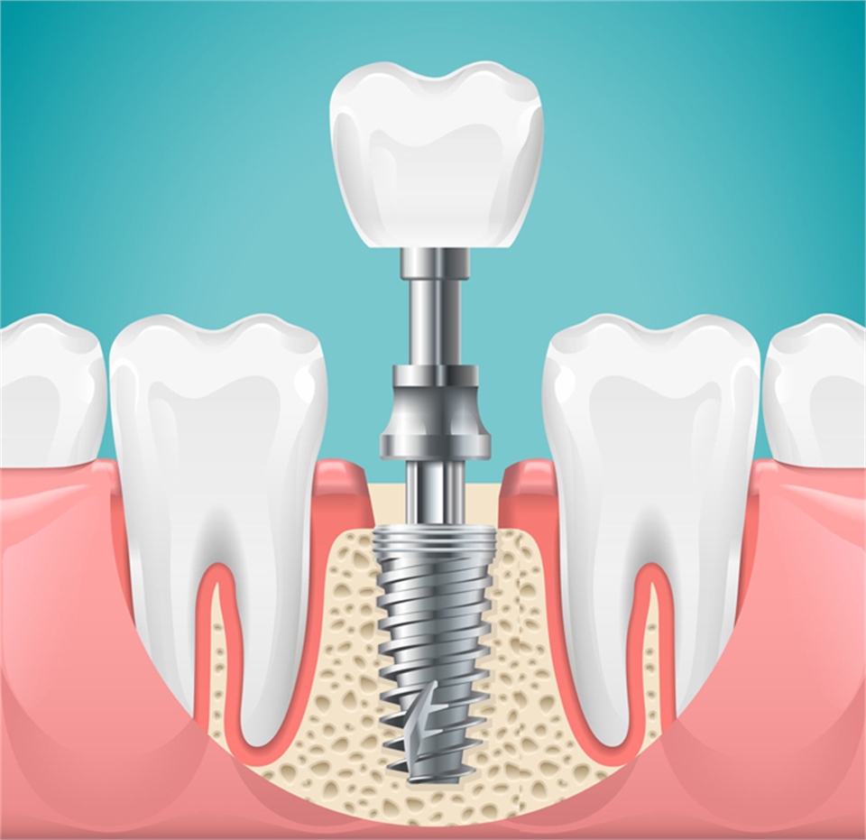 Dental Implants