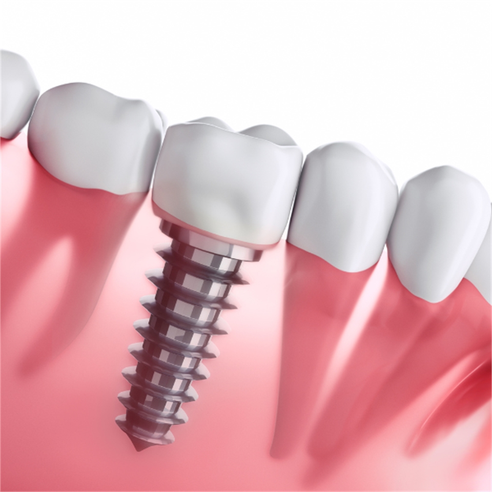 Dental implants Dentagama