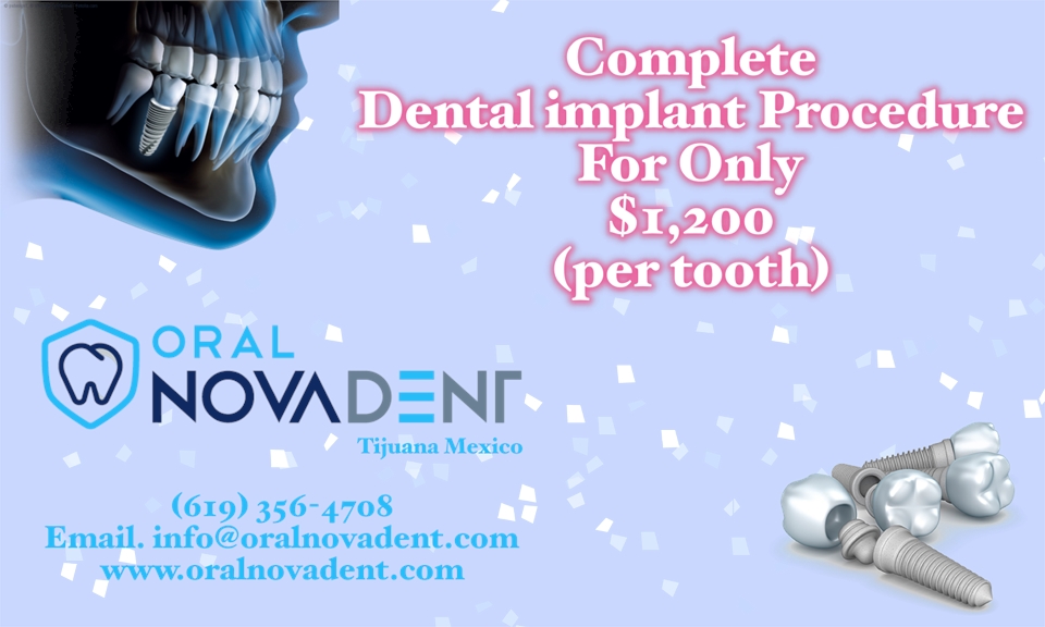 Dental Implants