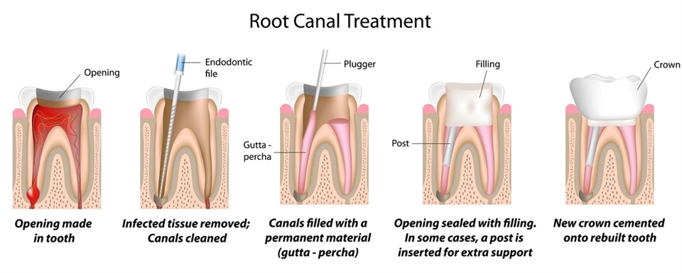 Root-canal