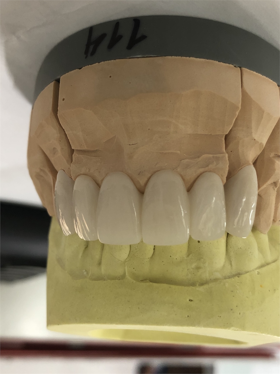 Zirconia overlayed