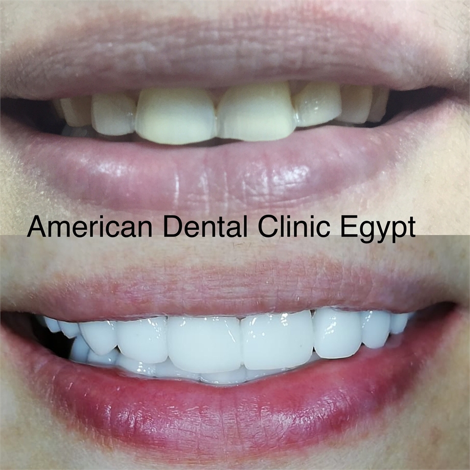 E-max Veneers