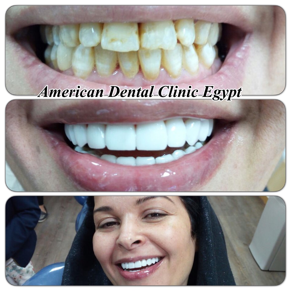 E-max Veneers