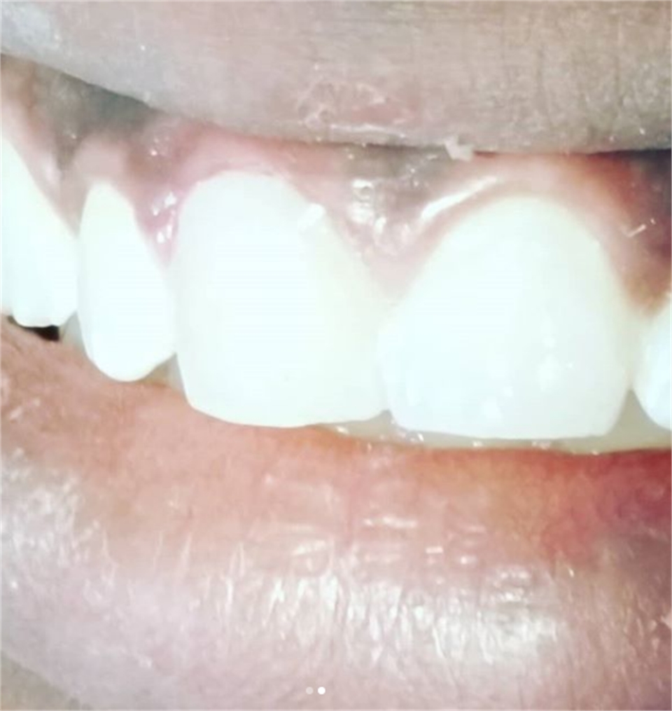 Teeth After