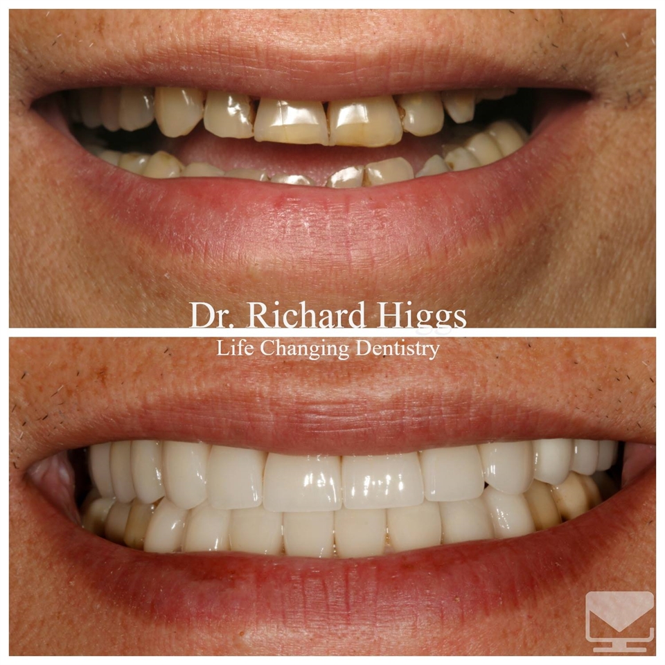 Trung Dental Implants Veneers and Crowns