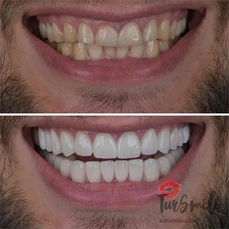 before after laminate veneers turkey