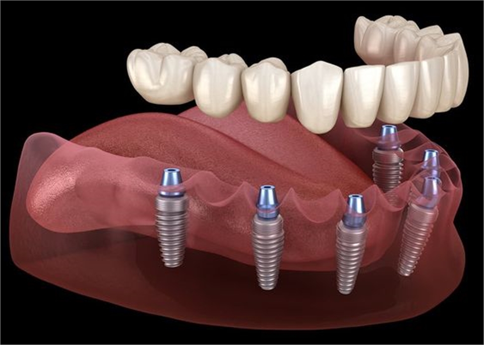 All on 6 dental implants turkey