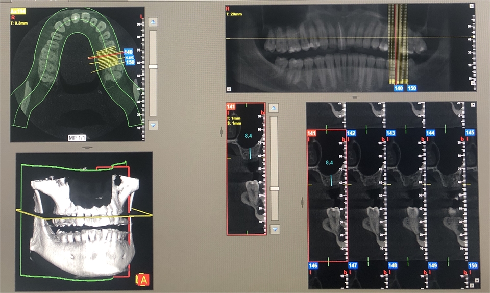 Wisdom Teeth Sydney - Wisdom Teeth Professionals