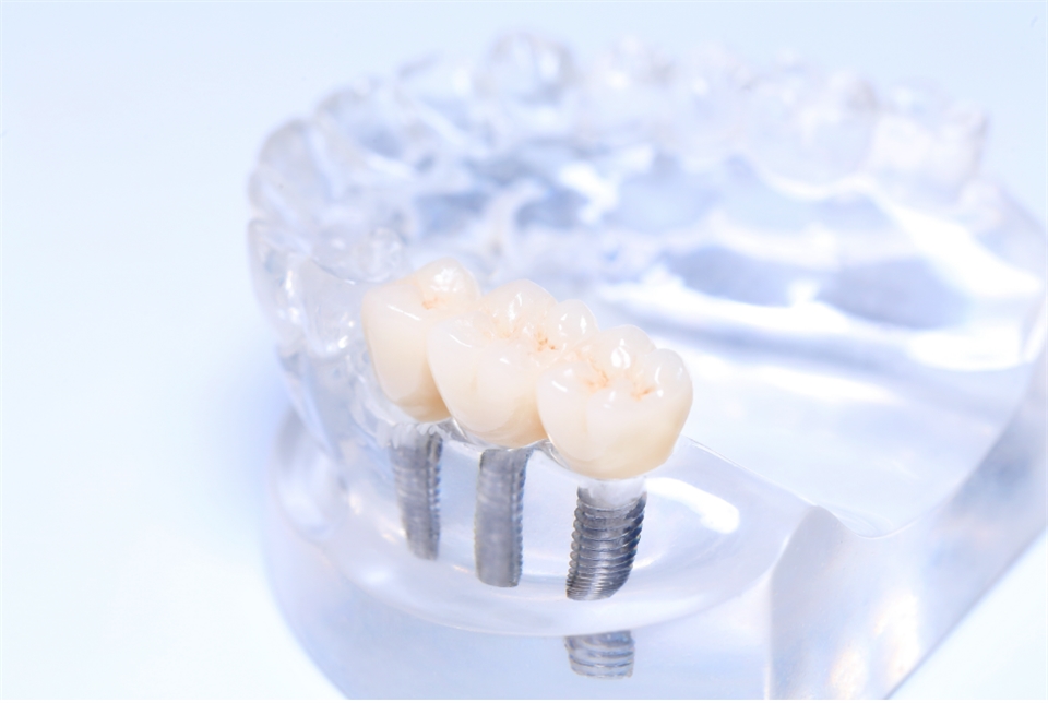 Zirconia PFM E.MAX Full Metal Crown