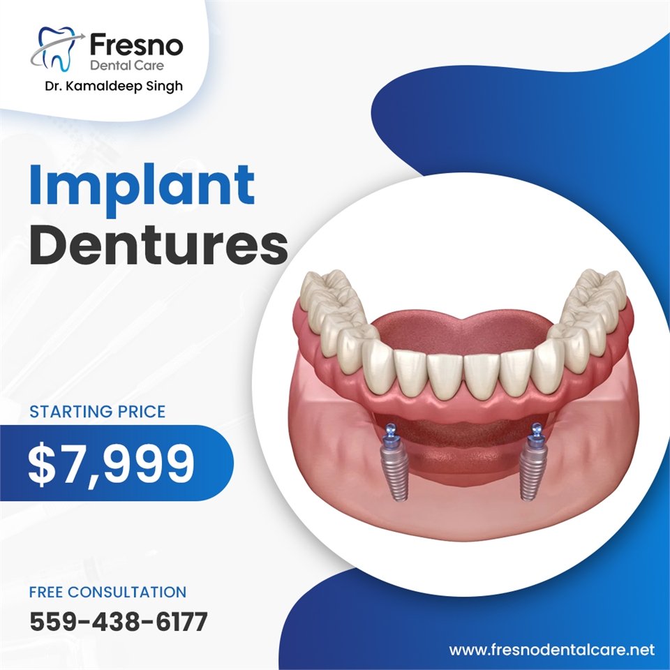 Implant Supported Dentures