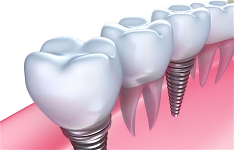 Dental-Implants-in-Sydney