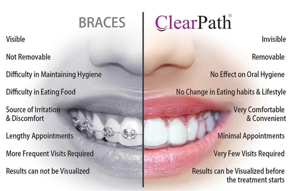 Clear Aligner