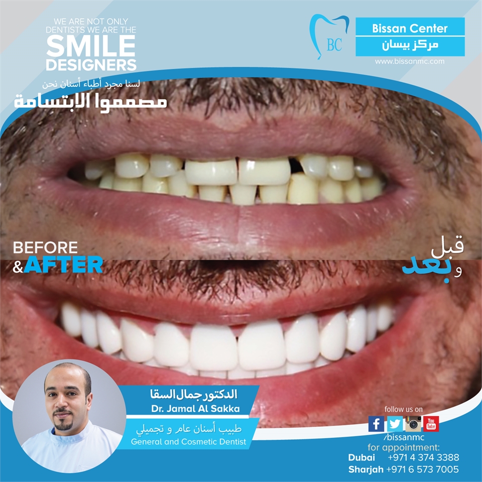 Full smile rehabilitation case.