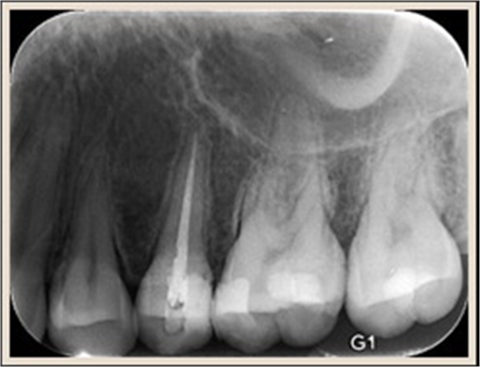 Root Canal