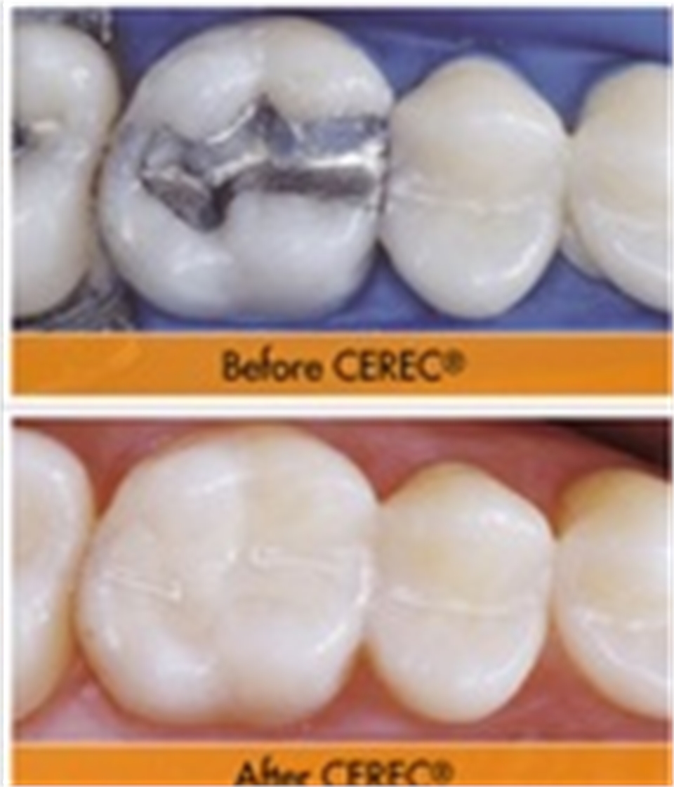 Ceramic Dentistry