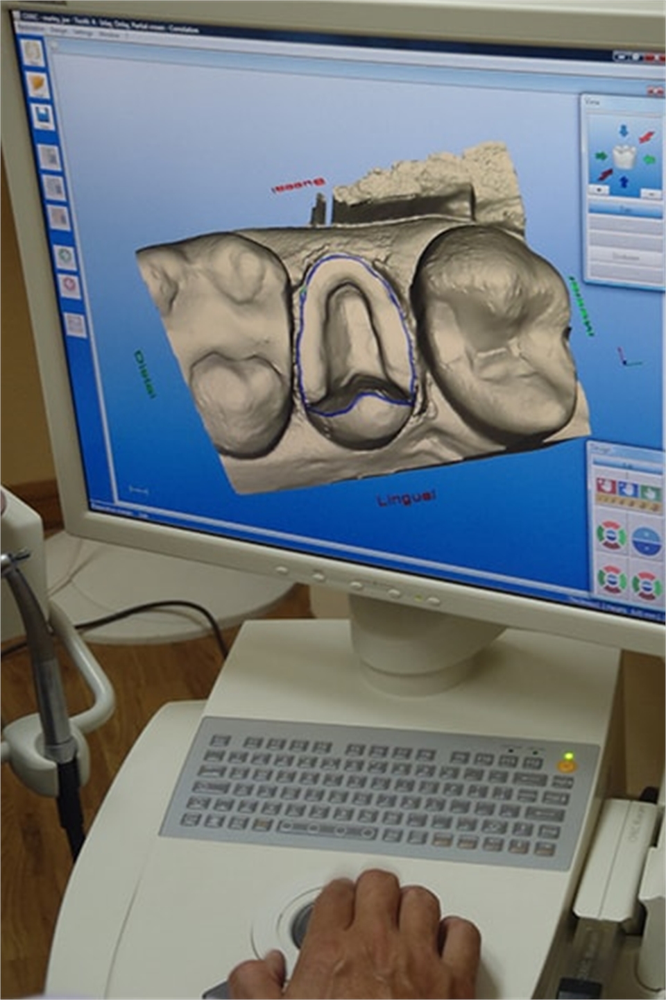 Cerec Machine at Longmont CO dentist Artistic Smiles