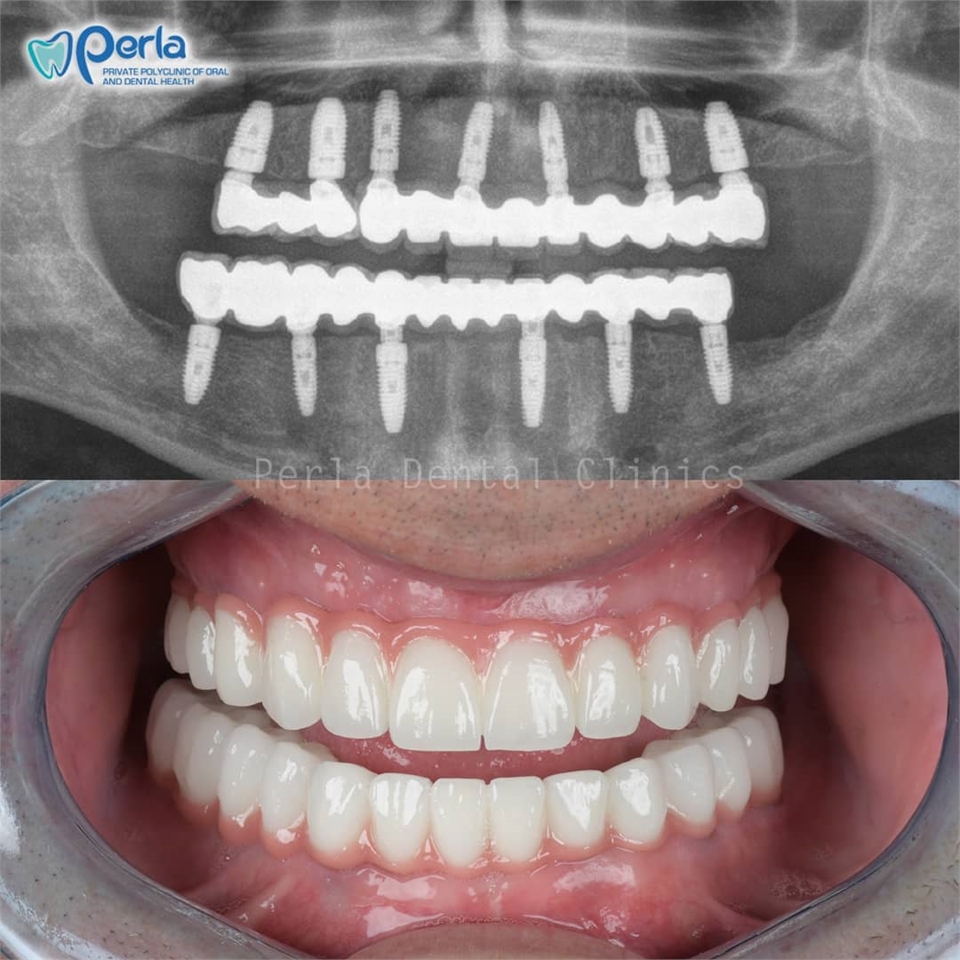 Full Mouth Dental Implant