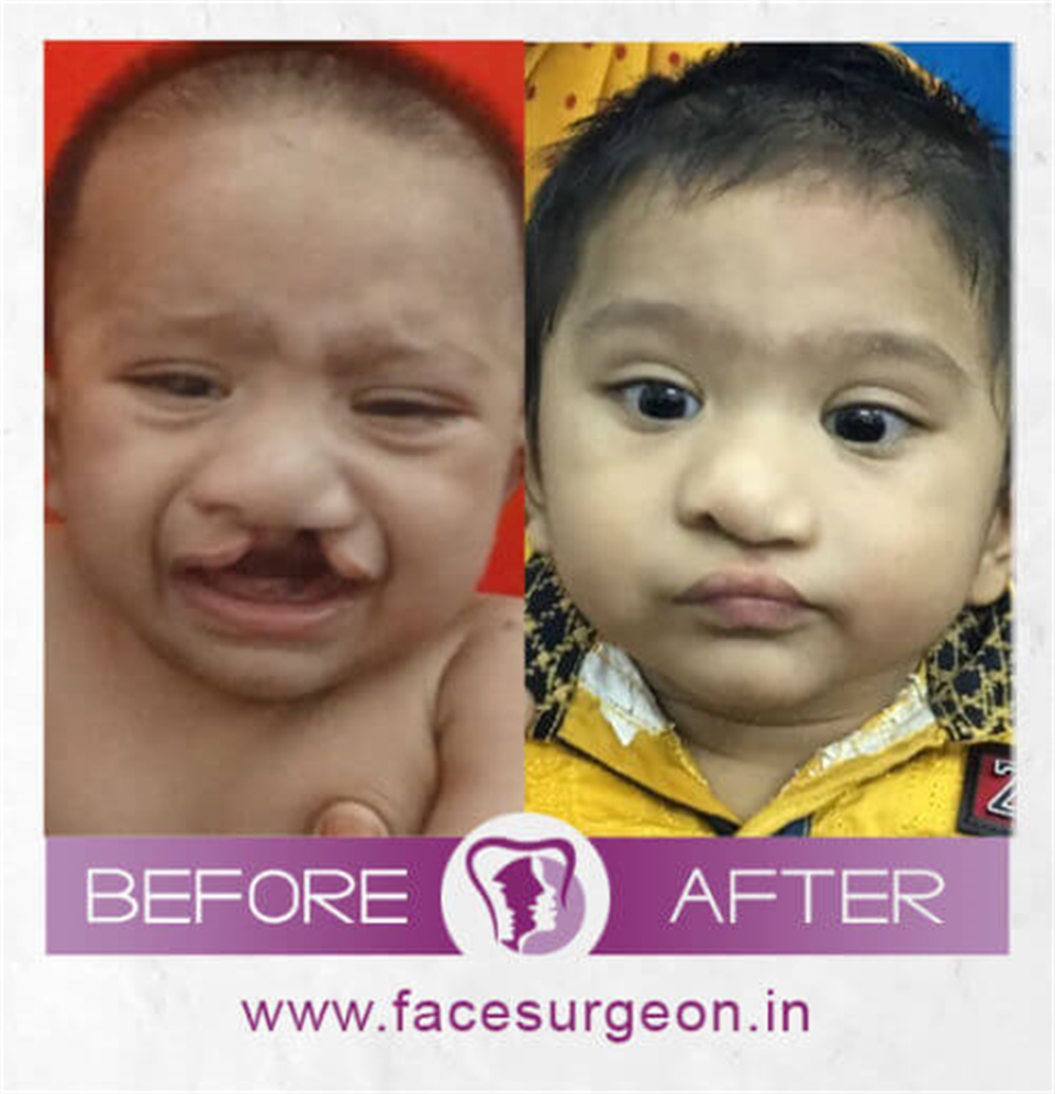 Why Richardsons for Cleft Lip and Palate