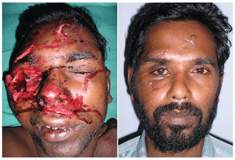 Trauma Surgery  Facial Fracture Treatment In India  Richardsons Dental