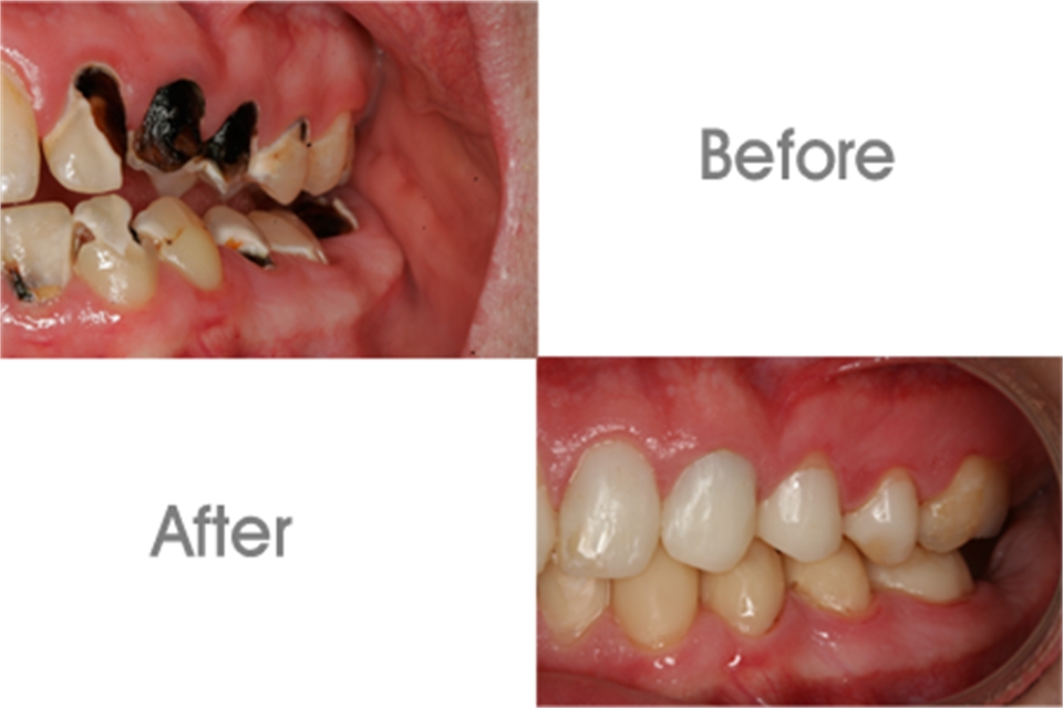 Dental Care Before And After