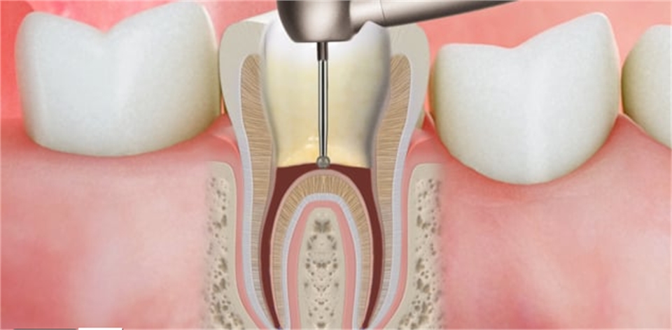 Root Canal