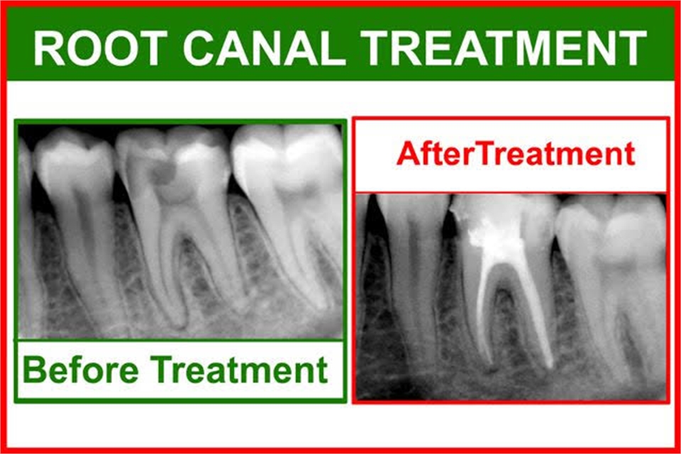 Root Canal Treatment Omaha NE