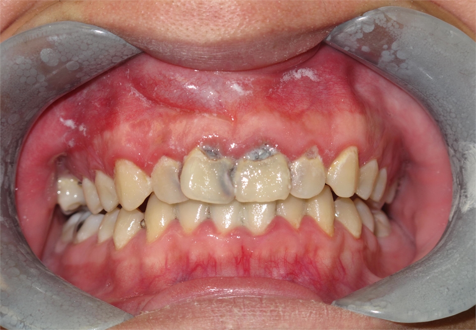 Tooth Decay Before Retracted 703 753 8600   Dentist Gainesville VA