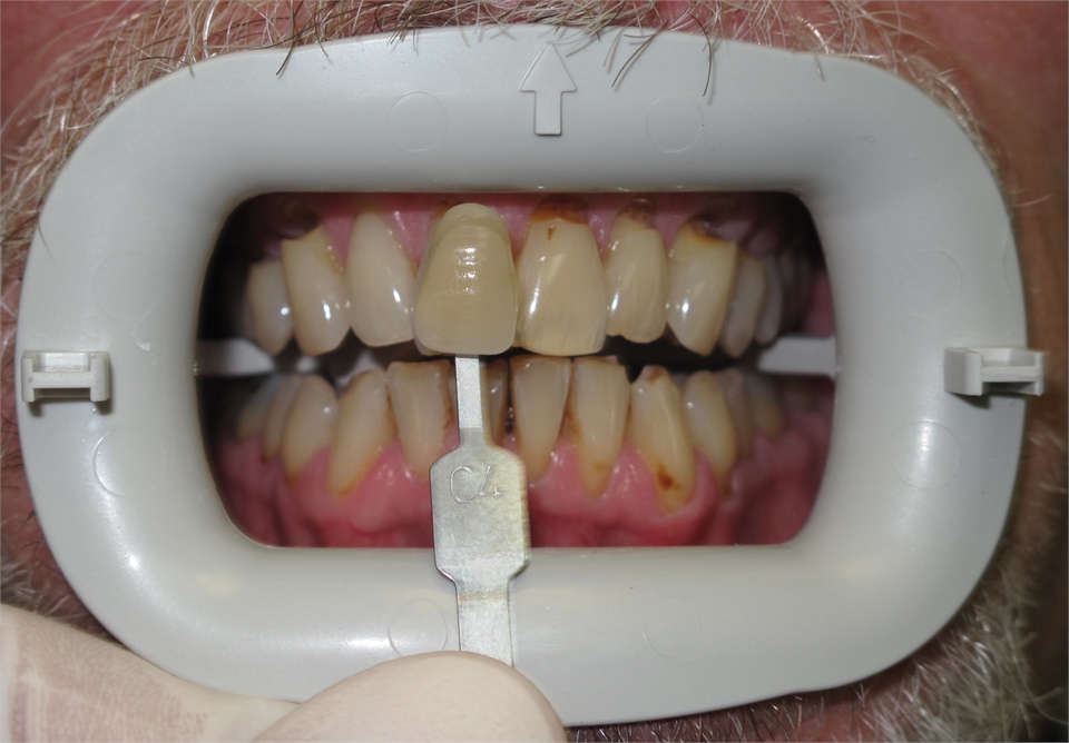 Whitening Before 703 753 8600 Dentist Gainesville VA