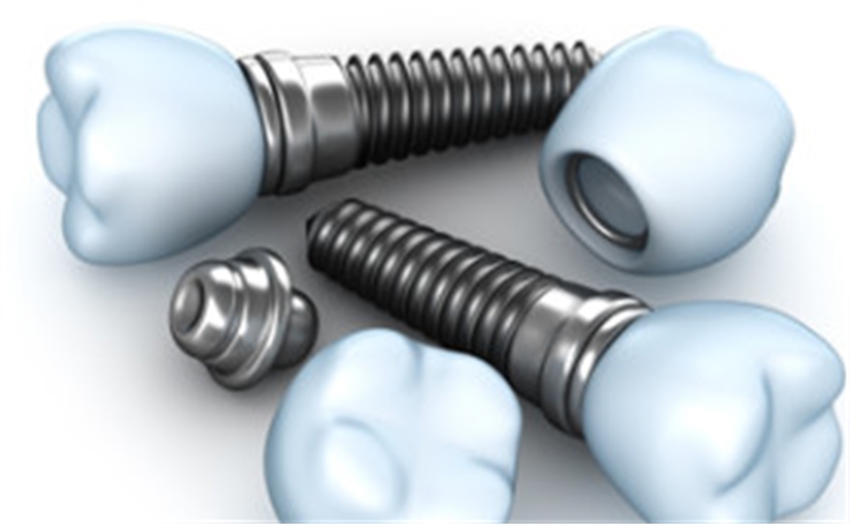 Affordable Dental Implants Melbourne