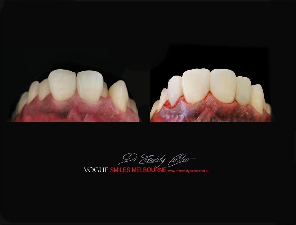 PORCELAIN DENTAL VENEERS SPECIALS AND PACKAGES MELBOURNE CBD -SMILE MAKEOVER BY VOGUE SMILES MELBOUR