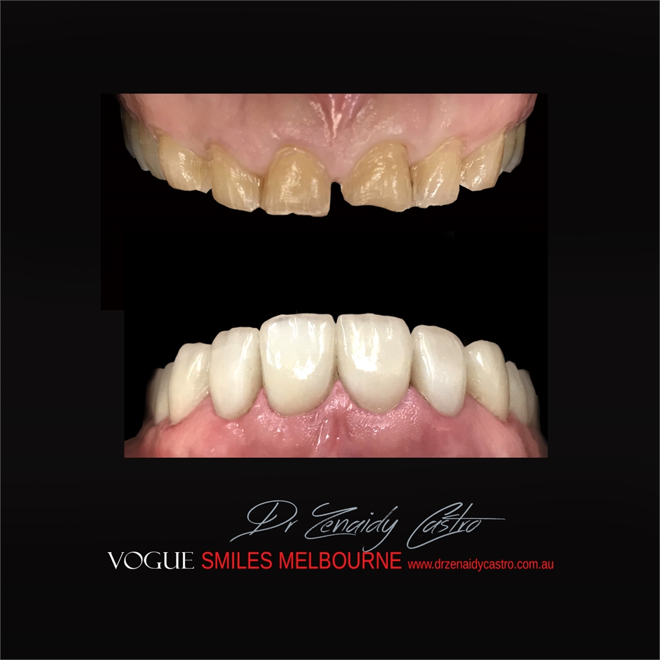 PORCELAIN DENTAL VENEERS SPECIALS AND PACKAGES MELBOURNE CBD -SMILE MAKEOVER BY VOGUE SMILES MELBOUR