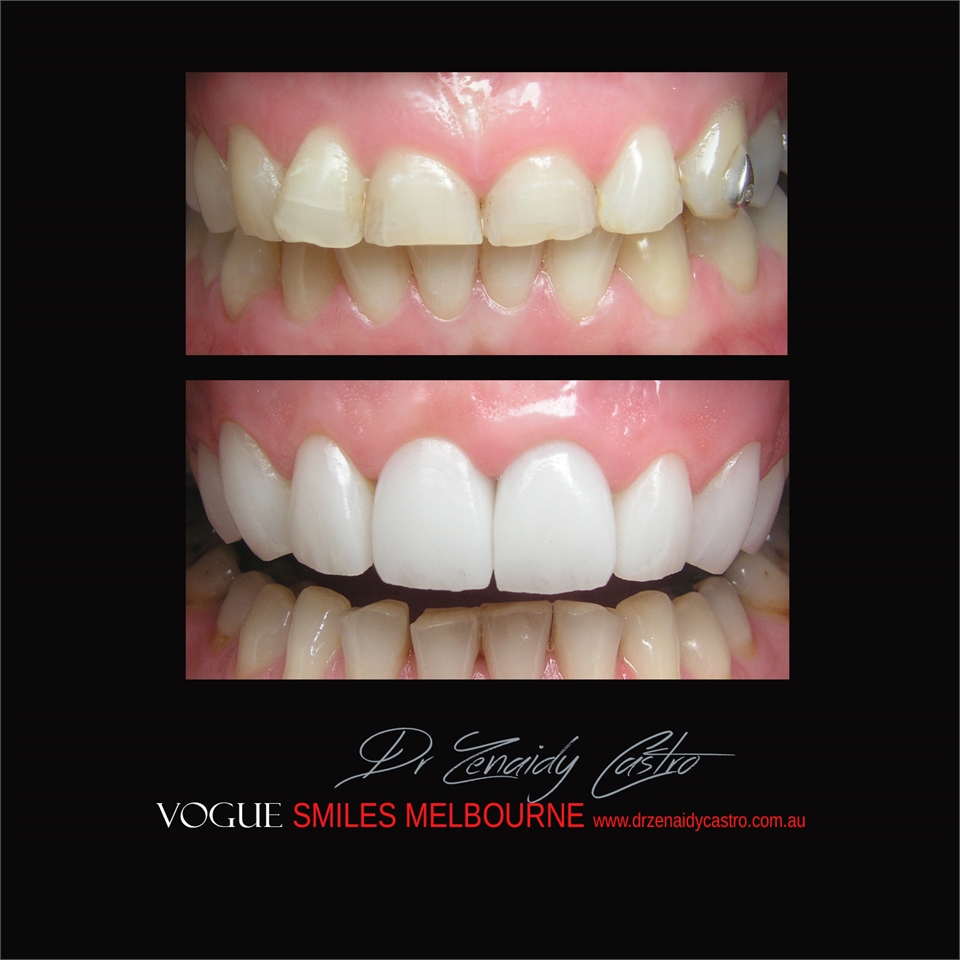 PORCELAIN DENTAL VENEERS SPECIALS AND PACKAGES MELBOURNE CBD -SMILE MAKEOVER BY VOGUE SMILES MELBOUR