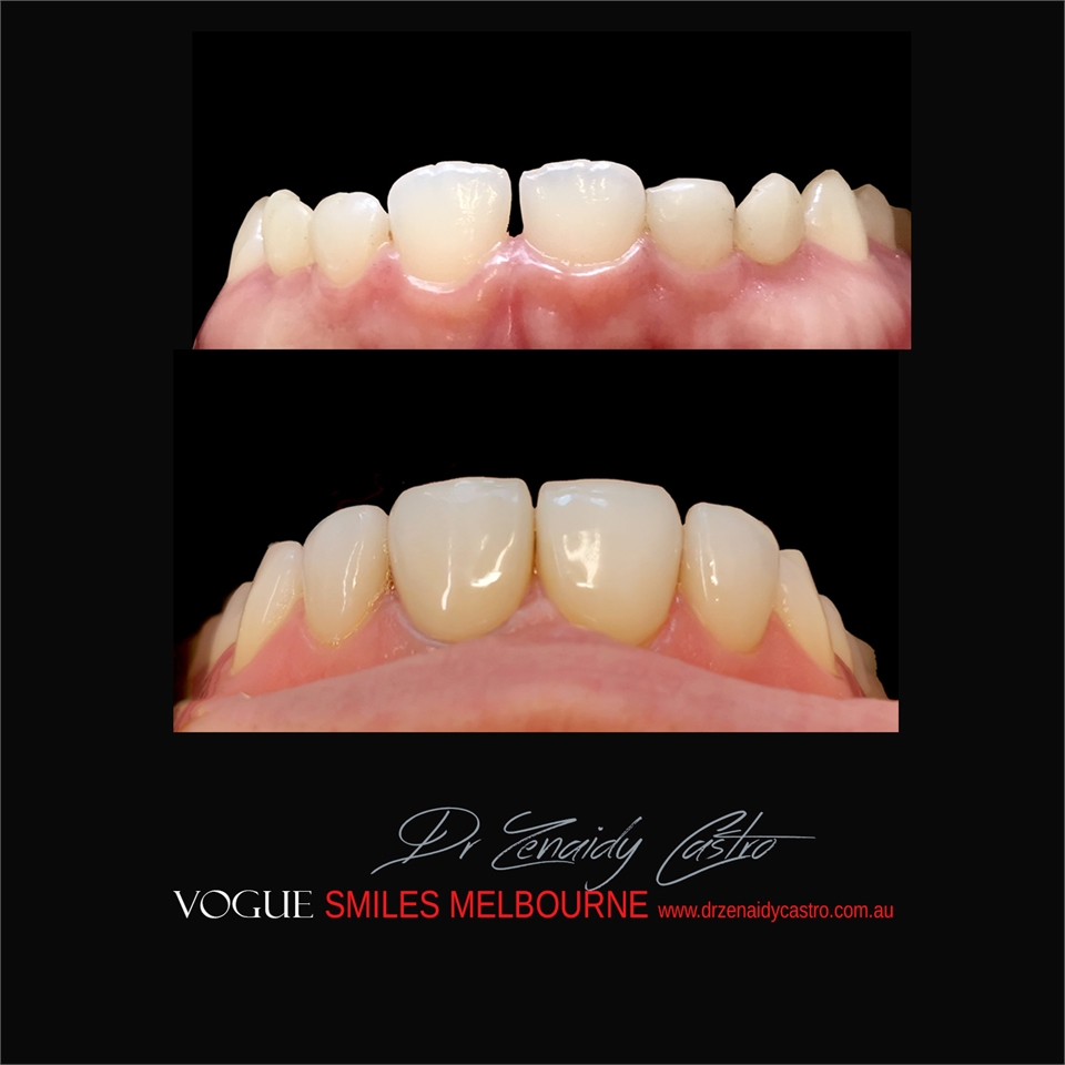 PORCELAIN DENTAL VENEERS SPECIALS AND PACKAGES MELBOURNE CBD -SMILE MAKEOVER BY VOGUE SMILES MELBOUR