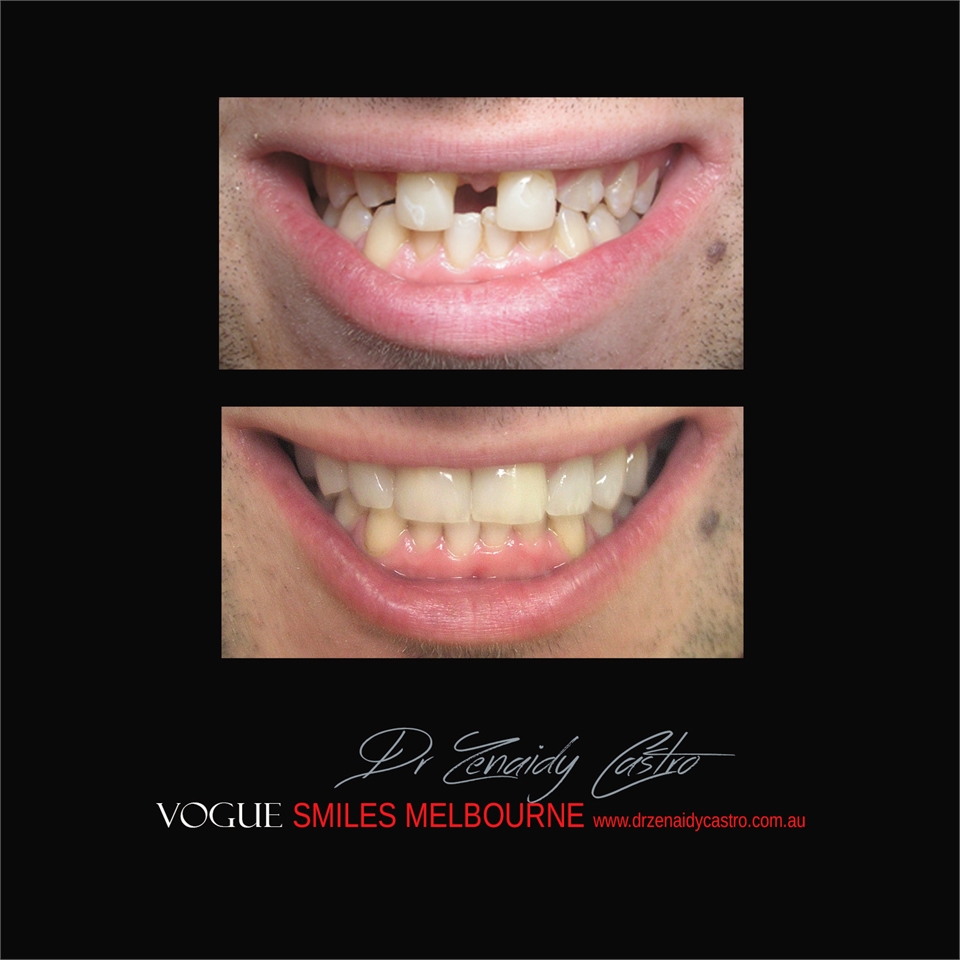 PORCELAIN DENTAL VENEERS SPECIALS AND PACKAGES MELBOURNE CBD -SMILE MAKEOVER BY VOGUE SMILES MELBOUR