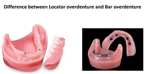 What is the difference between bar overdenture and locator overdenture?