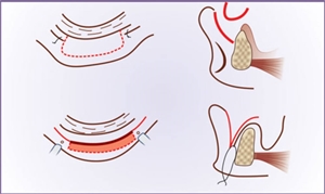 Vestibuloplasty or vestibulo-lingual sulcoplasty, is a dental procedure, which deepens the vestibule (sulcus) of the mouth, without disturbing the alveolar bone structure