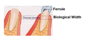 What is Ferrule in Dentistry?