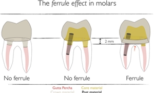 The ferrule effect in molar teeth