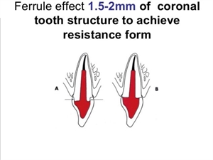 Ferrule consists of coronal tooth structure