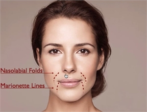 Marionette lines are facial wrinkles starting from the angle of the mouth and finishing at the chin