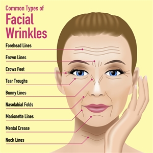 Facial wrinkles - forehead lines, frown lines, crows feet, tear troughs, bunny lines, nasolabial folds, marionette lines, mental crease, neck lines