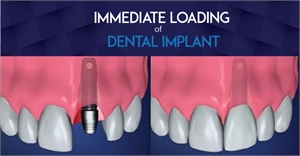 What is immediate loading of dental implants?